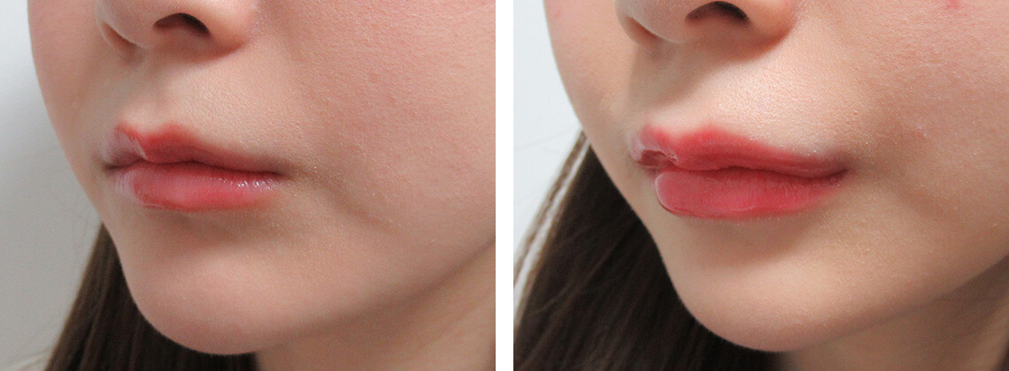 ラシャスリップス（医療機関専売）の症例写真 施術前後 １週間