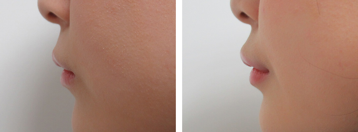 ラシャスリップス（医療機関専売）の症例写真 施術前後 １週間