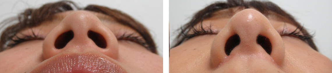 鼻尖形成・鼻尖縮小/TAC式 鼻翼縮小術（小鼻縮小）/鼻のヒアルロン酸注射の症例写真 施術前後 １ヵ月