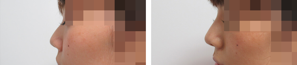 鼻尖形成・鼻尖縮小/TAC式 鼻翼縮小術（小鼻縮小）/鼻のヒアルロン酸注射の症例写真 施術前後 １ヵ月