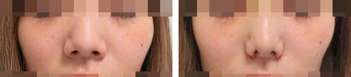 鼻尖形成・鼻尖縮小/TAC式 鼻翼縮小術（小鼻縮小）/鼻のヒアルロン酸注射の症例写真 施術前後 １週間