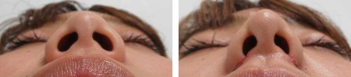鼻尖形成・鼻尖縮小/TAC式 鼻翼縮小術（小鼻縮小）/鼻のヒアルロン酸注射の症例写真 施術前後 １週間