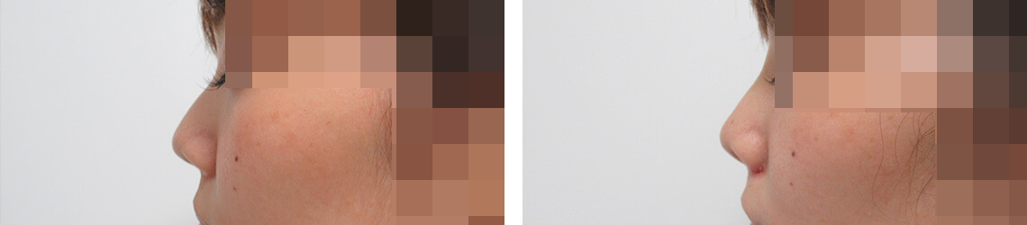 鼻尖形成・鼻尖縮小/TAC式 鼻翼縮小術（小鼻縮小）/鼻のヒアルロン酸注射の症例写真 施術前後 １週間