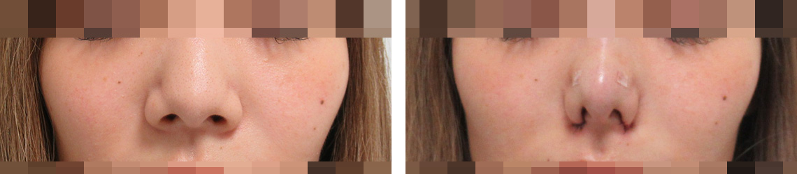 鼻尖形成・鼻尖縮小/TAC式 鼻翼縮小術（小鼻縮小）/鼻のヒアルロン酸注射の症例写真 施術前後 直後