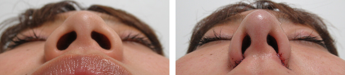 鼻尖形成・鼻尖縮小/TAC式 鼻翼縮小術（小鼻縮小）/鼻のヒアルロン酸注射の症例写真 施術前後 直後