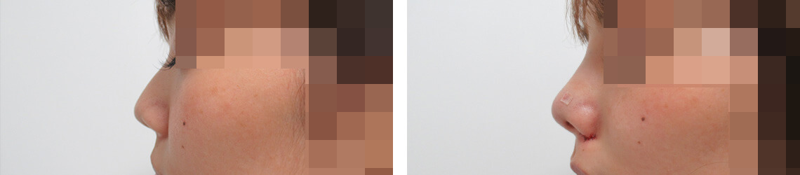 鼻尖形成・鼻尖縮小/TAC式 鼻翼縮小術（小鼻縮小）/鼻のヒアルロン酸注射の症例写真 施術前後 直後