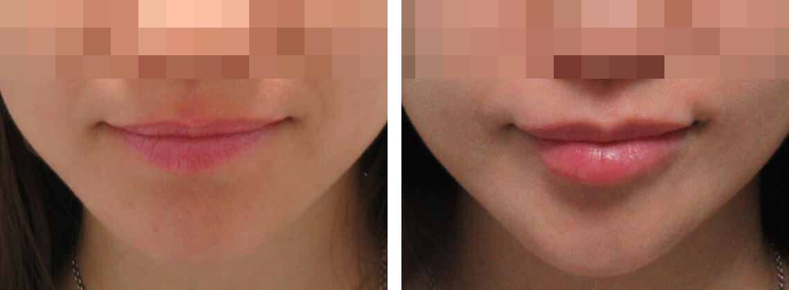 ラシャスリップス(医療機関専売)の症例写真 施術前後 1週間