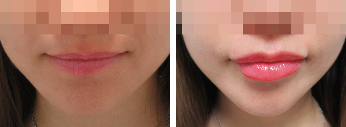 ラシャスリップス(医療機関専売)の症例写真 施術前後 1週間