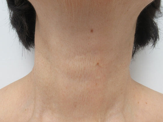 症例写真 ダウンタイム 首のシワを長期的な治療で解消 Taクリニック 美容整形 美容外科