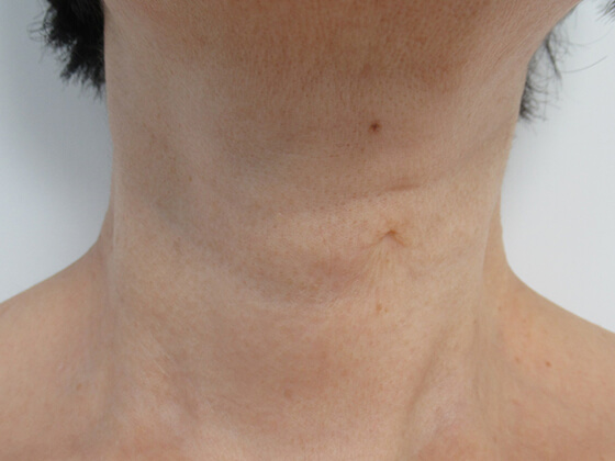 症例写真 ダウンタイム 首のシワを長期的な治療で解消 Taクリニック 美容整形 美容外科