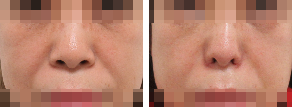 TAC式 鼻翼縮小術（小鼻縮小）の症例写真 施術前後 １週間