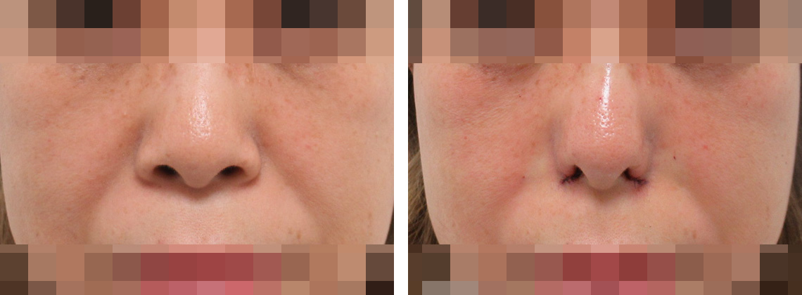 TAC式 鼻翼縮小術（小鼻縮小）の症例写真 施術前後 直後