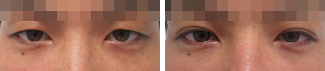 男性のセクシーな二重ライン