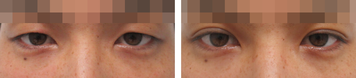 二重埋没法の症例写真 施術前後 １週間