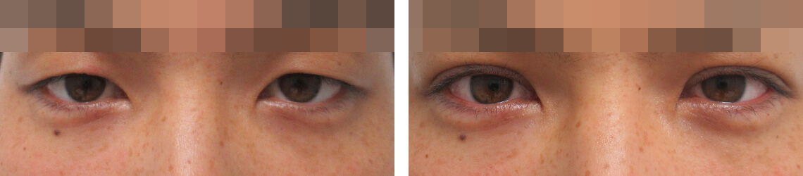 二重埋没法の症例写真 施術前後 直後