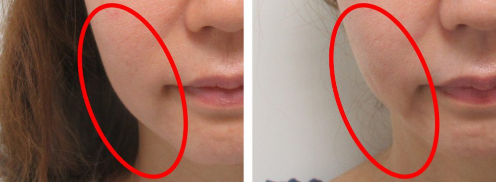 マリオネットラインのたるみ