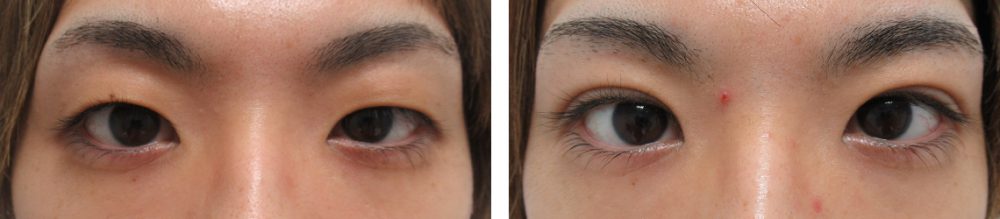 男性の自然な二重ライン