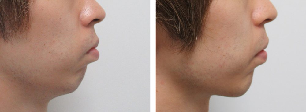 低い顎を整える