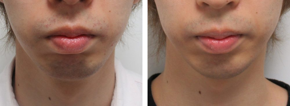 顎のヒアルロン酸注射/ボトックス注射：その他の症例写真 施術前後 １ヵ月