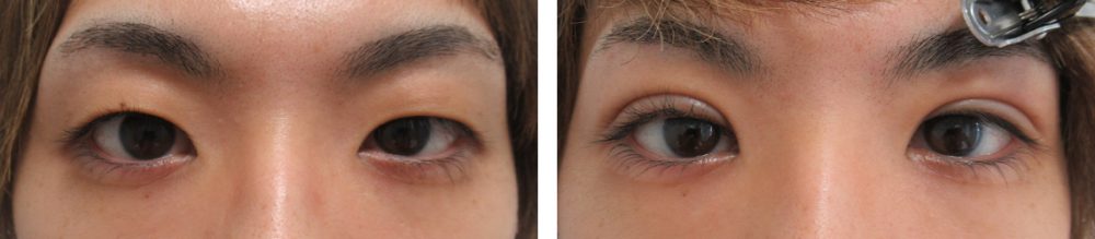 二重埋没法の症例写真 施術前後 １週間