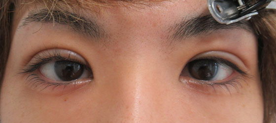 症例写真 ダウンタイム 男性の自然な二重ライン Taクリニック 美容整形 美容外科