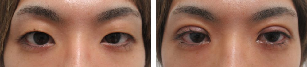 二重埋没法の症例写真 施術前後 直後