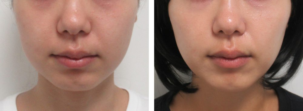 バレにくい自然なリフトアップの仕上がり