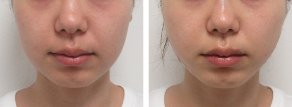 TAC式 ツヤ肌コラーゲンリフト®/ボトックス注射：その他の症例写真 施術前後 直後