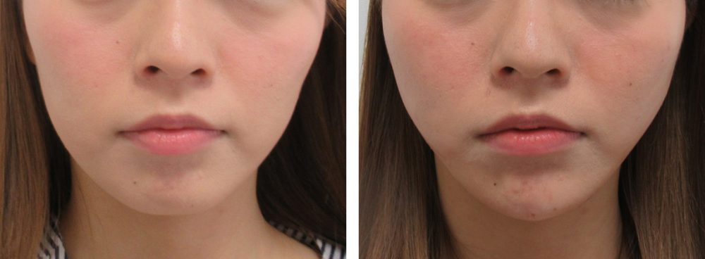 TAC式 ツヤ肌コラーゲンリフト®/顎のヒアルロン酸注射/エラボトックス注射の症例写真 施術前後 直後