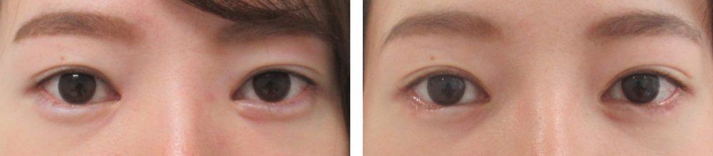 グラマラスライン（タレ目形成）の症例写真 施術前後 １ヵ月半