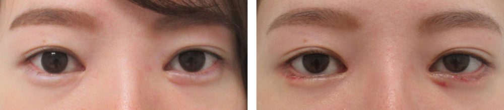 グラマラスライン（タレ目形成）の症例写真 施術前後 １週間