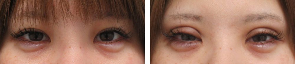 二重埋没法の症例写真 施術前後 直後