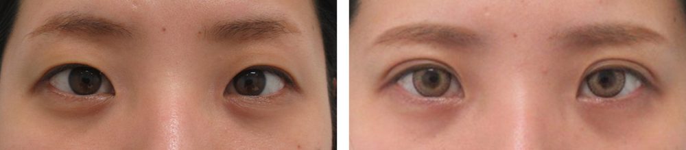 末広型で幅広二重にしたい