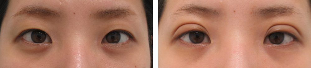 二重埋没法の症例写真 施術前後 １週間