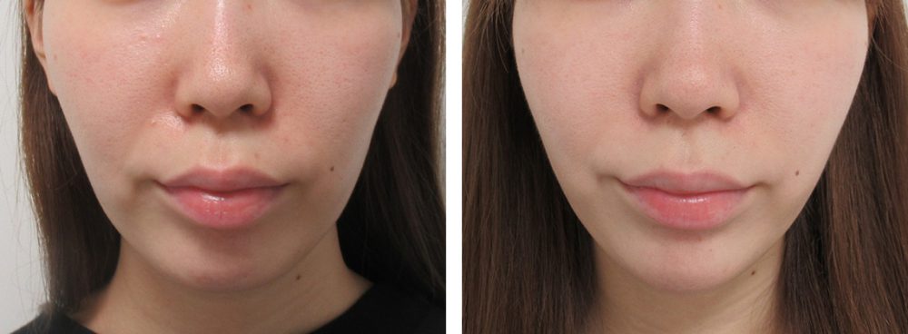 口角のもたつき