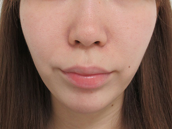 症例写真 ダウンタイム 口角のもたつき Taクリニック 美容整形 美容外科