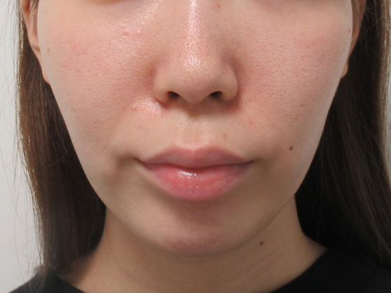 症例写真 ダウンタイム 口角のもたつき Taクリニック 美容整形 美容外科