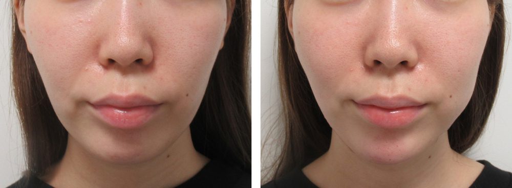 TAC式 ツヤ肌コラーゲンリフト®/顎のヒアルロン酸注射/ボトックス注射：その他の症例写真 施術前後 直後