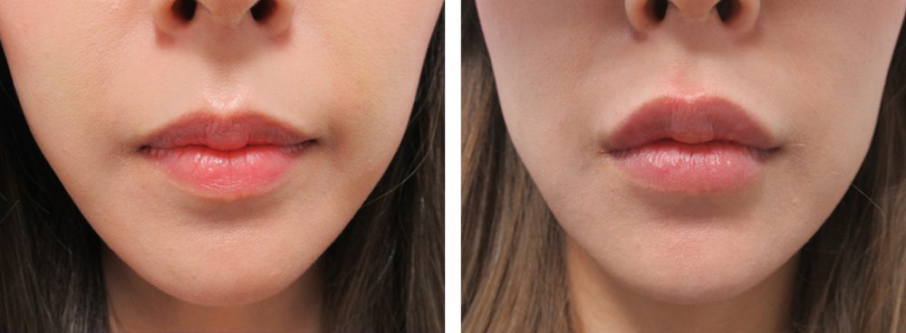 ぽってリップなアヒル口