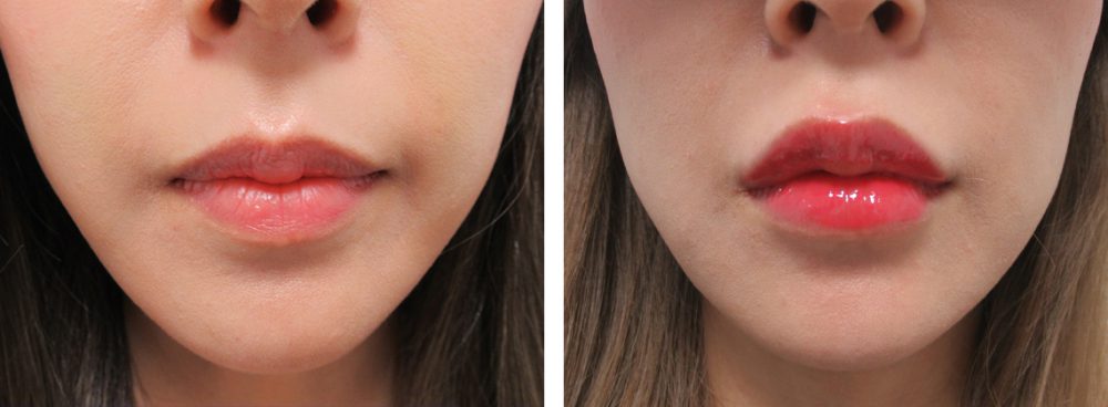 ラシャスリップス(医療機関専売)の症例写真 施術前後 1ヵ月(ラシャスリップスあり)