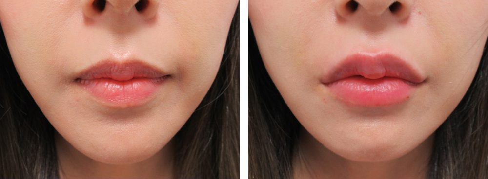 ラシャスリップス(医療機関専売)の症例写真 施術前後 直後