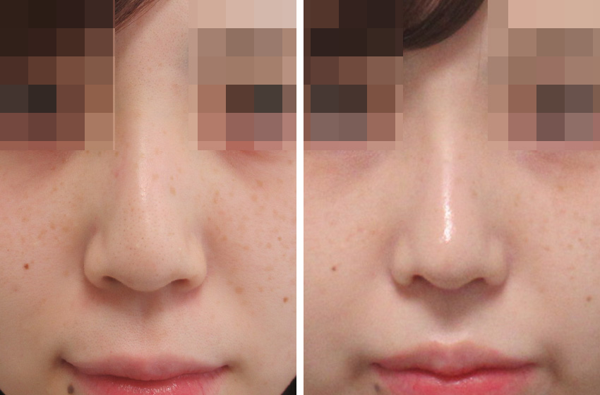 オルチャン鼻とハーフ鼻のいいとこ取り