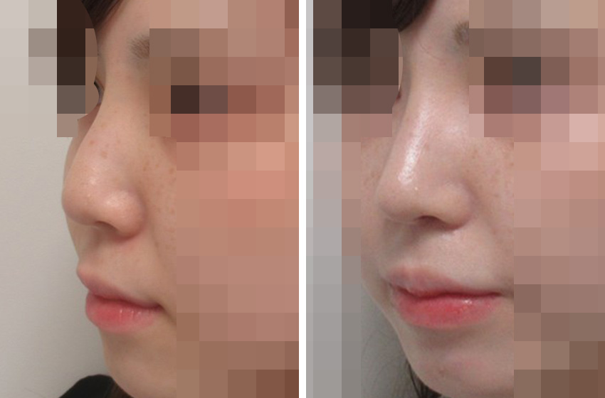 隆鼻術（プロテーゼ・自家組織）/ヴィーナスノーズ（切らない鼻中隔延長術）/TAC式 鼻翼縮小術（小鼻縮小）の症例写真 施術前後 １ヵ月