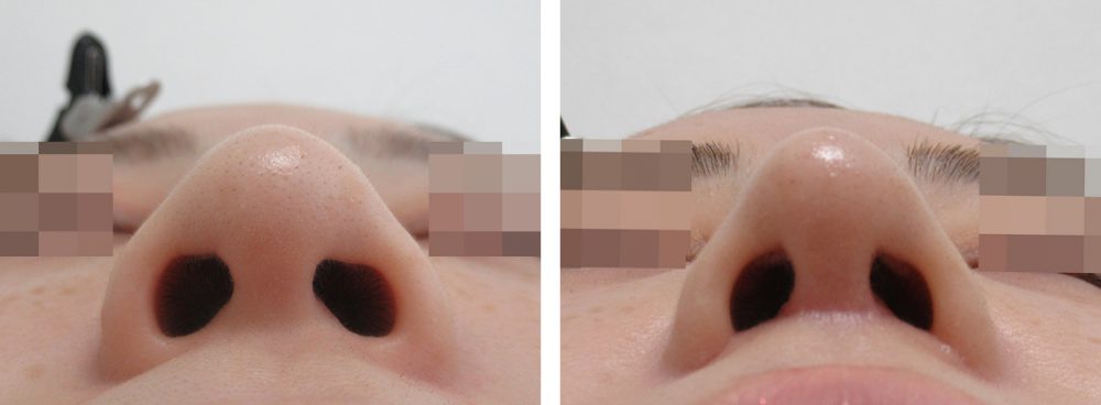 隆鼻術（プロテーゼ・自家組織）/ヴィーナスノーズ（切らない鼻中隔延長術）/TAC式 鼻翼縮小術（小鼻縮小）の症例写真 施術前後 １ヵ月