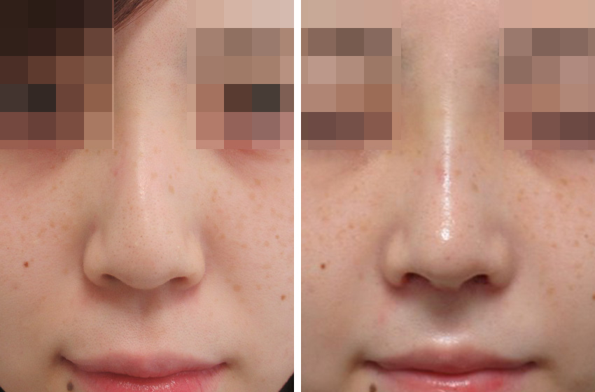 隆鼻術（プロテーゼ・自家組織）/ヴィーナスノーズ（切らない鼻中隔延長術）/TAC式 鼻翼縮小術（小鼻縮小）の症例写真 施術前後 １週間