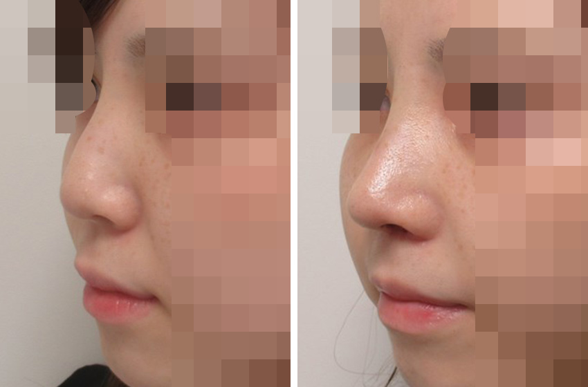 隆鼻術（プロテーゼ・自家組織）/ヴィーナスノーズ（切らない鼻中隔延長術）/TAC式 鼻翼縮小術（小鼻縮小）の症例写真 施術前後 １週間