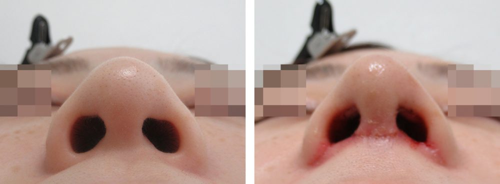 隆鼻術（プロテーゼ・自家組織）/ヴィーナスノーズ（切らない鼻中隔延長術）/TAC式 鼻翼縮小術（小鼻縮小）の症例写真 施術前後 １週間