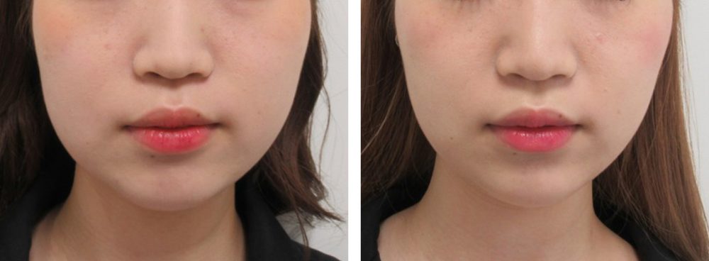 TAC式 ツヤ肌コラーゲンリフト®/バッカルファット除去の症例写真 施術前後 リフトアップ6ヵ月