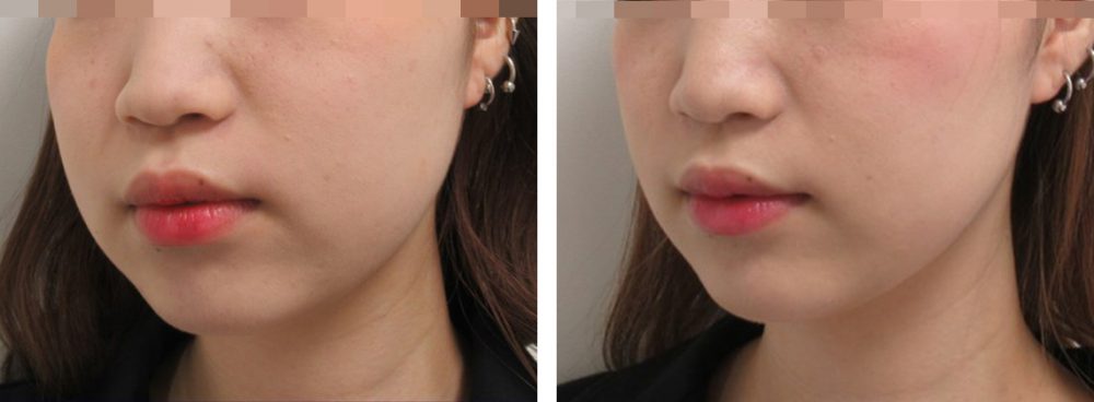 TAC式 ツヤ肌コラーゲンリフト®/バッカルファット除去の症例写真 施術前後 リフトアップ6ヵ月