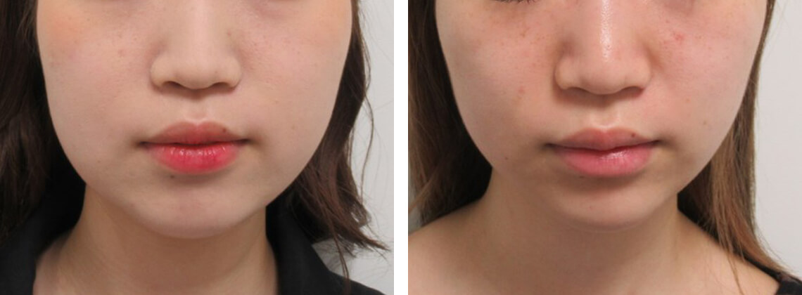 バッカルファット除去とリフトアップ